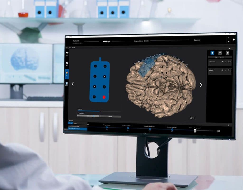 cortiQ software on screen: ECoG electrodes on the brain's surface