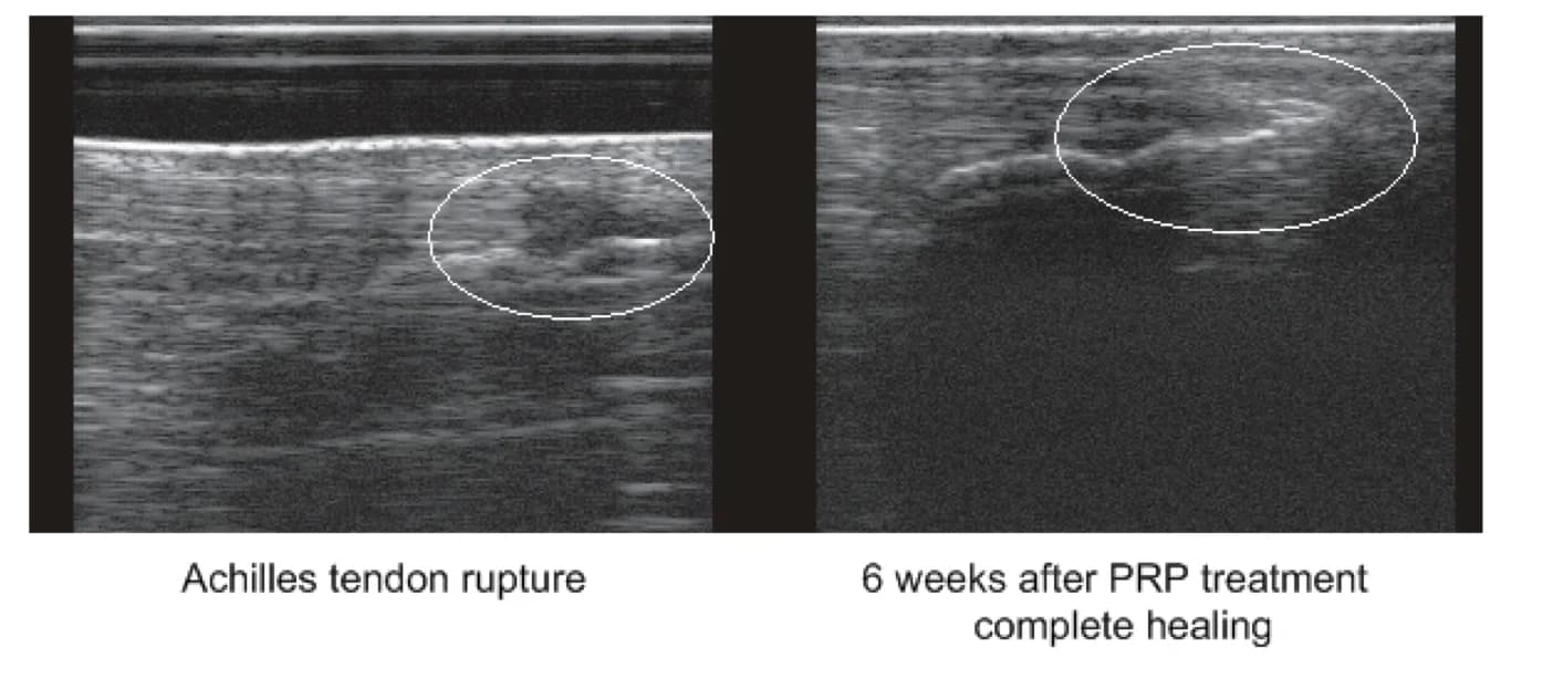 Baseline and six-week ultrasound follow-up of an Achilles tendon lesion
