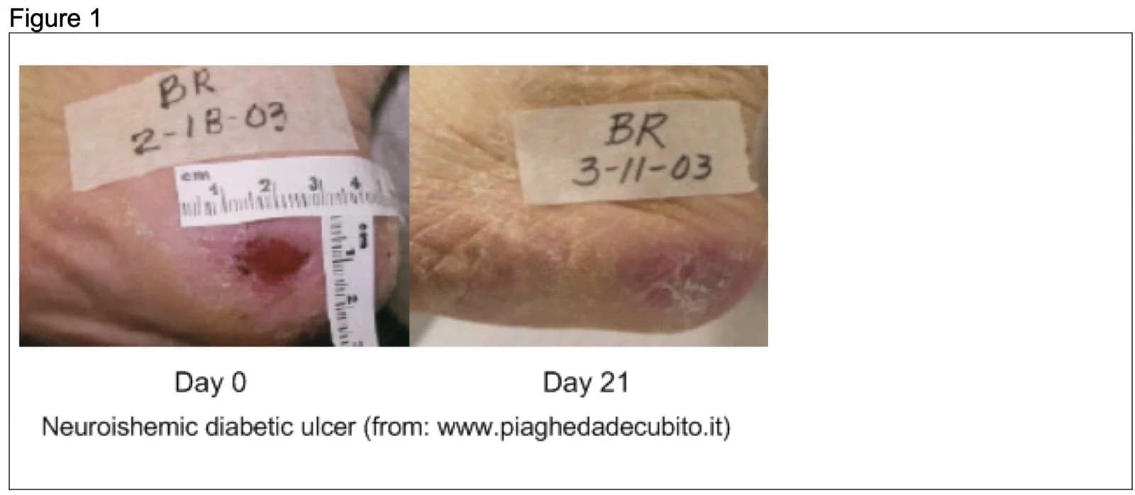 Neuroischaemic diabetic ulcer at day 0 and day 21