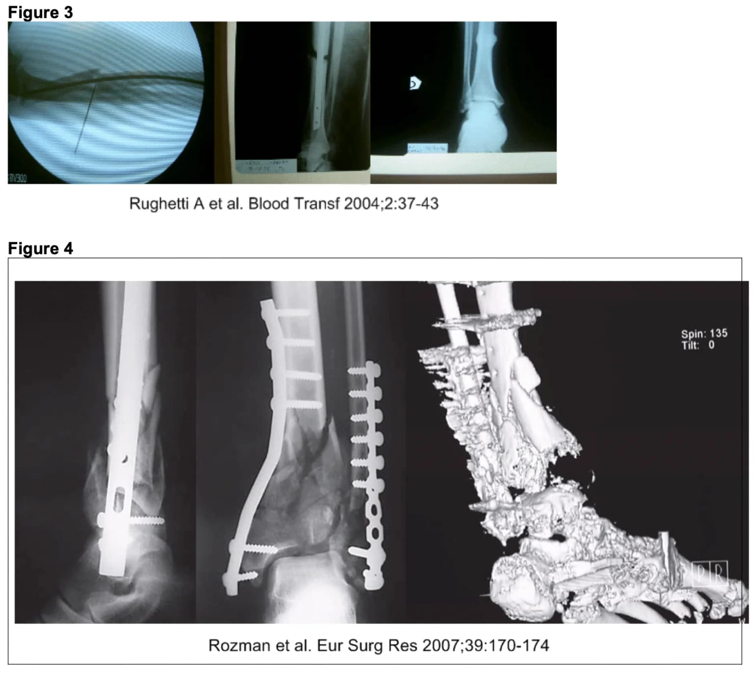 Radiographs and three-dimensional CT image of bone cases