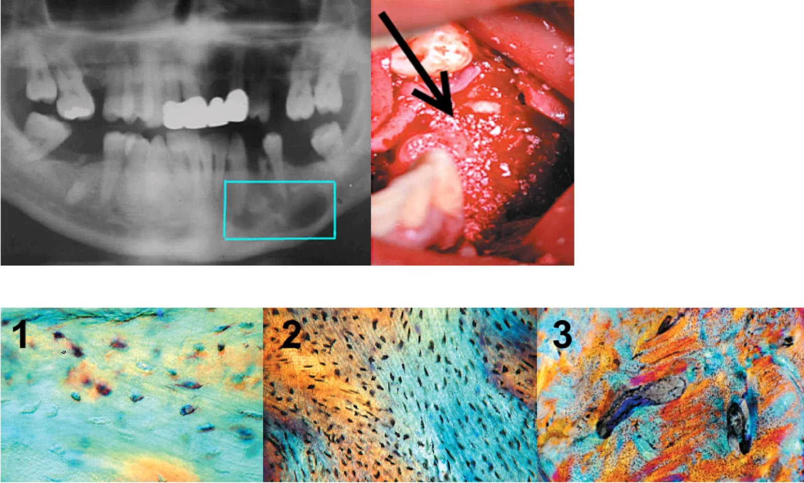 Mandibular bone defect and three histological panels
