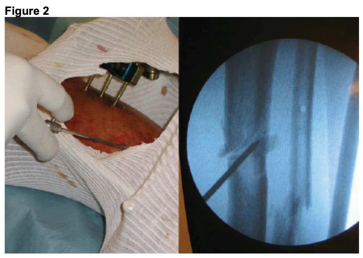 Orthopaedic procedure and radiological control images