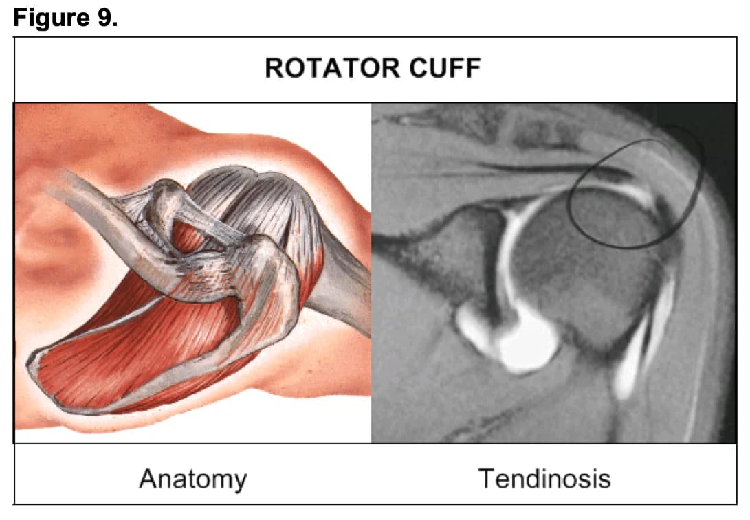 Rotator cuff anatomy and MRI of a tendon lesion
